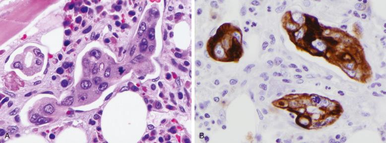 Figure 58-4, Metastatic adenocarcinoma of the lung in a bone marrow biopsy (A) and expressing the cytokeratin CK7 (B).