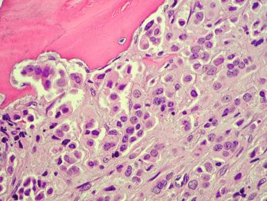 Figure 58-5, Metastatic prostate cancer in a bone marrow biopsy.