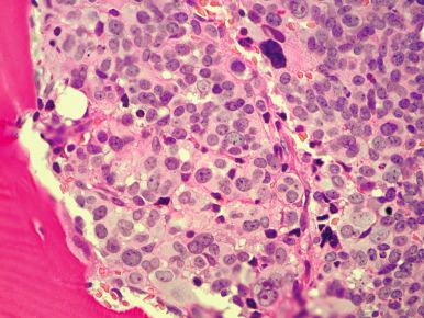 Figure 58-6, Bone marrow biopsy specimen extensively involved with metastatic colon carcinoma.