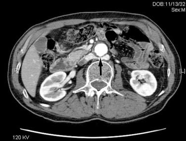 FIG 60.2, Computed tomography scan demonstrating a retroaortic left renal vein (arrow) in a patient with an abdominal aortic aneurysm.