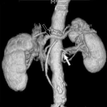 FIG 60.3, Magnetic resonance imaging reconstruction of a circumaortic renal vein (black arrow) . Note the caudal position of the posterior branch (white arrow) .