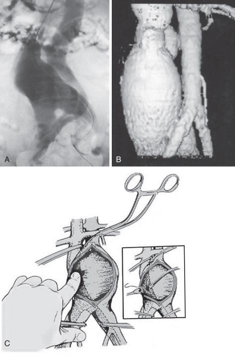 FIG 60.4, (A) Abdominal angiogram showing filling of the vena cava from an aortic aneurysm. (B) Magnetic resonance angiogram showing a traumatic aortocaval fistula. (C) The fistula orifice is exposed through the aneurysm and controlled by simple digital occlusion of the hole into the inferior vena cava. The fistula is closed with interrupted Prolene pledgetted sutures from within the aneurysmal sac. A clear and unencumbered field is provided by rapid aspiration and autotransfusion of blood pouring into the aneurysmal sac from the cava.