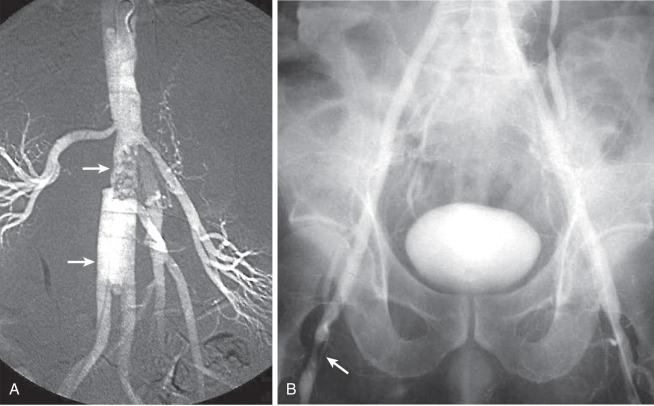 FIG 60.6, (A) Digital subtraction angiogram demonstrating progression of atherosclerosis above an aortofemoral graft (upper arrow) . The graft is placed well below the renal arteries and the body of the graft is too long (lower arrow) . (B) High-grade stenosis caused by intimal hyperplasia at the distal limb of an aortofemoral graft (arrow) .