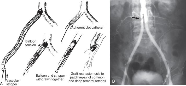 FIG 60.7, (A) A ring endarterectomy stripper is used in conjunction with a balloon catheter or adherent clot catheter to remove thrombus and pseudointima adherent to the wall of an occluded limb of an aortofemoral graft. The cleared graft limb is then sutured to the common or deep femoral outflow after patch angioplasty. (B) Intraoperative arteriogram demonstrating residual thrombus (arrow) in the proximal right limb of an aortobifemoral graft after attempted thrombectomy.