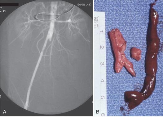 FIG 60.8, (A) Angiogram of the occluded limb of an aortofemoral graft. (B) The operative specimen demonstrating the thrombus and plaque removed from the proximal superficial femoral and profunda femoris arteries.