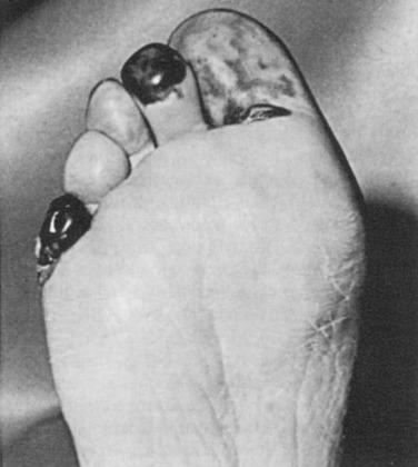 FIG 60.9, Atheroembolic ischemic lesions of the toes.