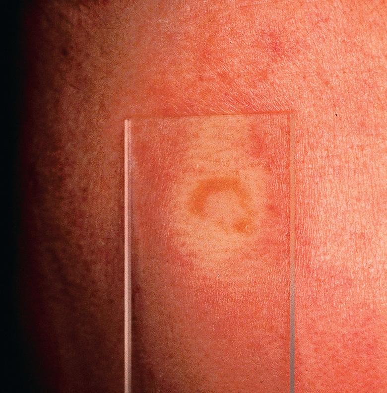 Fig. 93.4, Cutaneous sarcoidosis – diascopy.