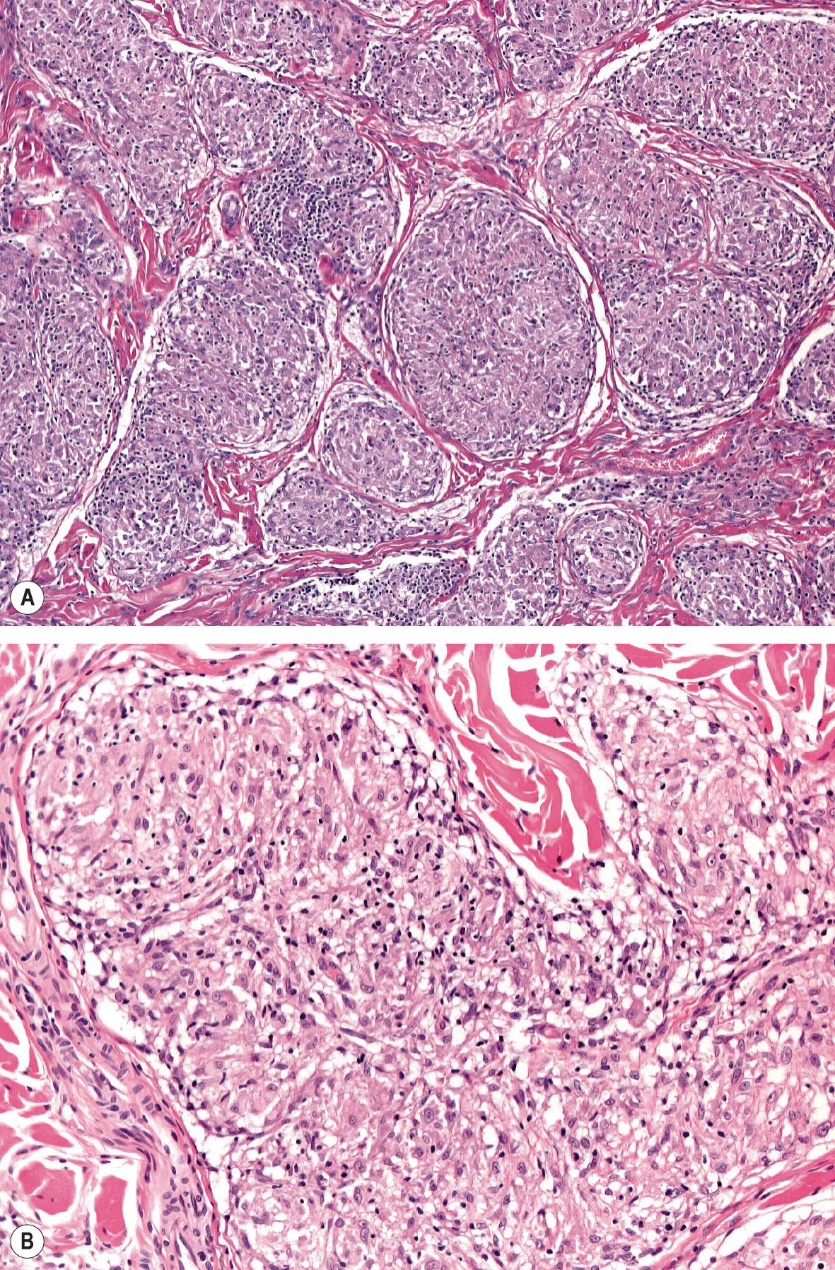 Fig. 93.6, Cutaneous sarcoidosis – histopathologic features.