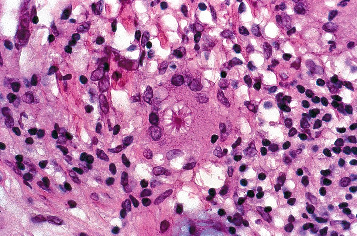 Fig. 93.7, Cutaneous sarcoidosis – histopathologic features.