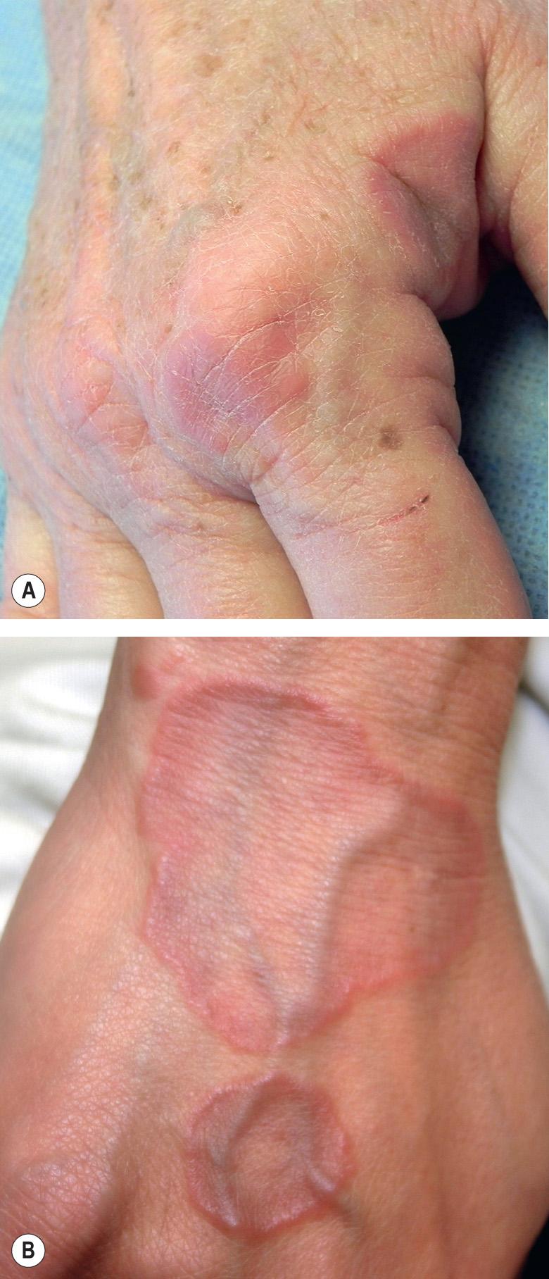 Fig. 93.8, Granuloma annulare – clinical features.