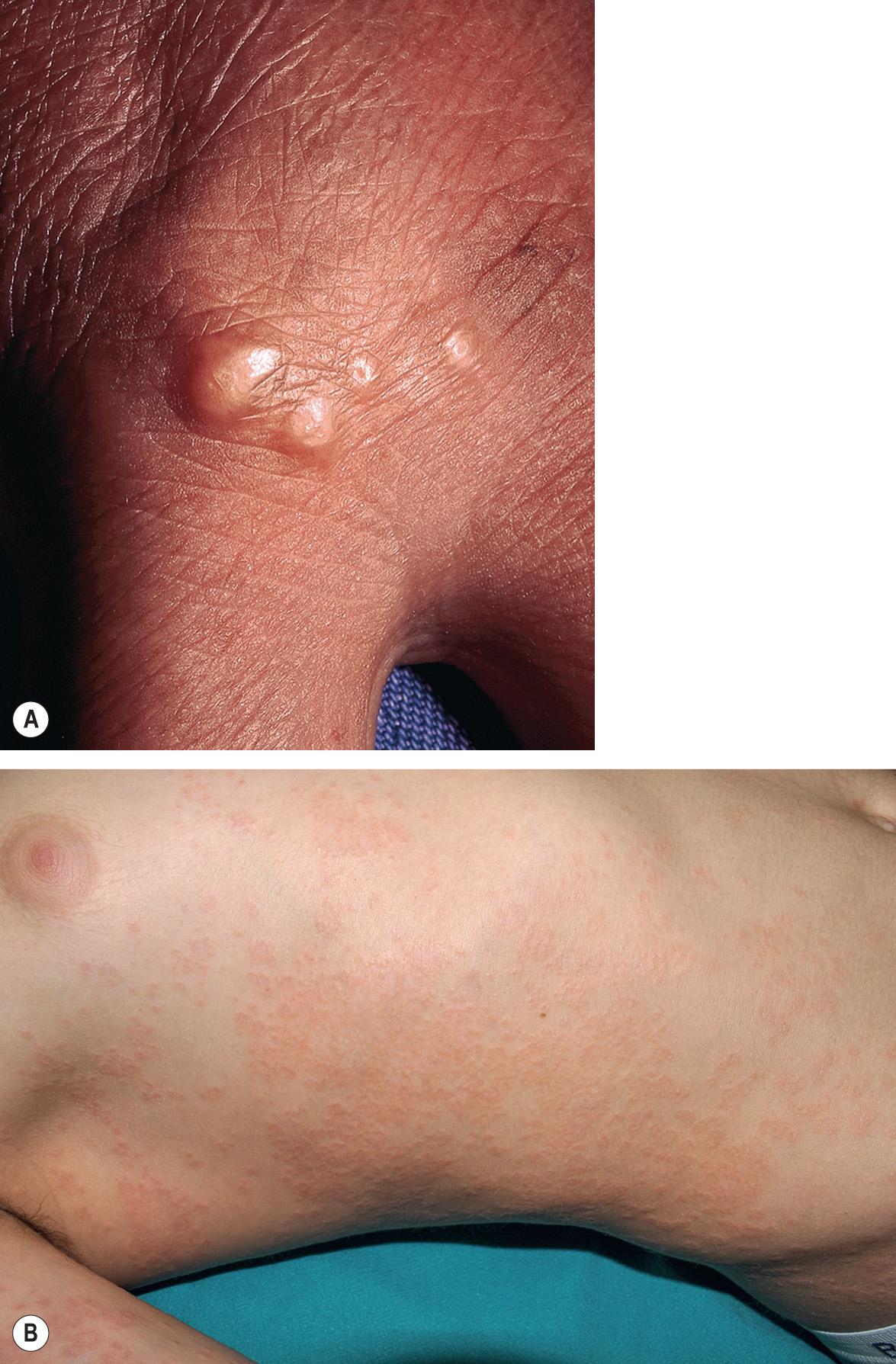 Fig. 93.10, Granuloma annulare – perforating and generalized/disseminated variants.