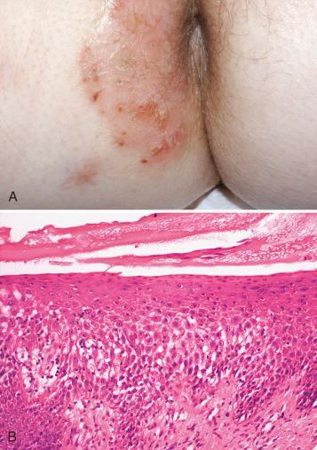 Fig. 2.1, A, Eczematous dermatitis presenting as a pruritic, erythematous, scaly rash. B, Eczematous dermatitis, showing spongiosis and sparse intraepithelial mononuclear cell infiltrate.