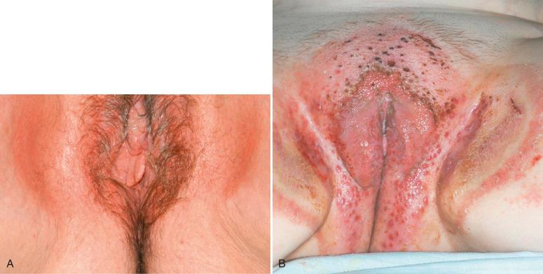 Fig. 2.2, A , Allergic contact dermatitis. This symmetric erythema on the vulva was secondary to benzocaine found in Vagisil anti-itch cream. B, Symmetric erythema with erosive nodular papulodermatosis over the vulva, extending to the thighs and buttocks.