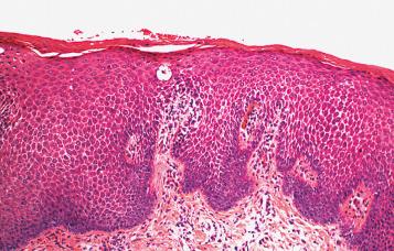 Fig. 2.3, Eczematous dermatitis with superimposed lichen simplex chronicus.