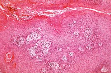 Fig. 2.4, Candida infection may mimic chronic eczematous dermatitis.