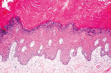 Fig. 2.6, Lichen simplex chronicus, with acanthosis, marked hyperkeratosis, and hypergranulosis.