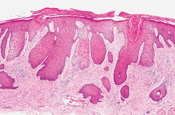 Fig. 2.7, Marked acanthosis associated with scratching (prurigo nodularis).