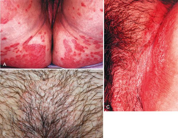 Fig. 2.8, A, Plaque psoriasis involving the buttocks and thighs. B, A typical plaque composed of confluent reddish bumps with a silvery scale. C, Flexural psoriasis.