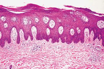 Fig. 2.9, Psoriasis. The rete ridges show regular elongation, with fusion at their bases. Note the confluent parakeratosis typical of psoriasis.