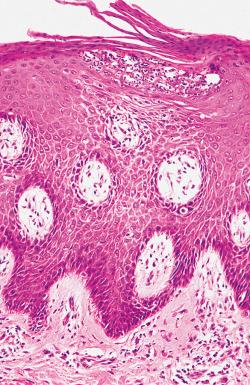 Fig. 2.10, Psoriasis. Shown is a superficial, intraepidermal neutrophil-rich microabscess (spongiform pustule of Kogoj).