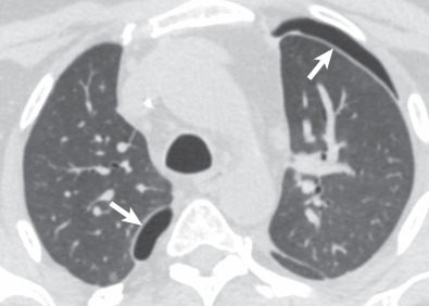 Fig. 70.3, Pneumothorax. CT image shows small bilateral pneumothoraces (arrows) in a patient approximately 2 weeks after bilateral lung transplantation. The left pneumothorax resolved spontaneously, but the right pneumothorax persisted and was due to bronchial anastomotic dehiscence.