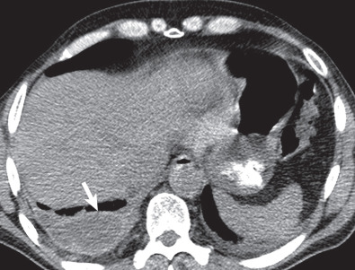 Fig. 70.4, Empyema several months after bilateral lung transplantation. CT image shows a small loculated right pleural effusion with pleural thickening (arrow), representing an empyema.