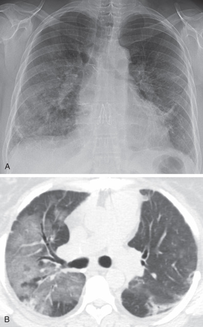 Fig. 70.6, Acute cellular rejection in a patient with dyspnea and hypoxemia several months after lung transplantation. (A) Radiograph shows bilateral patchy airspace opacities. (B) CT image shows bilateral ground-glass opacities, with greater involvement of the right lung.