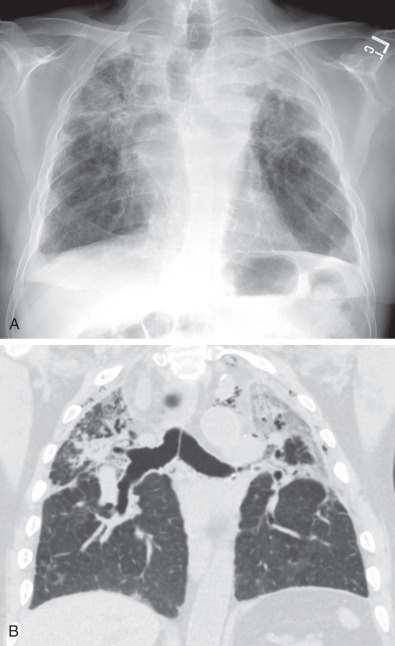 Fig. 70.7, Restrictive allograft syndrome in a patient approximately 2 years after bilateral lung transplantation. (A) Radiograph shows upper lobe volume loss, architectural distortion, and patchy opacities. (B) CT image shows upper lobe peripheral reticulation, architectural distortion, and traction bronchiectasis.