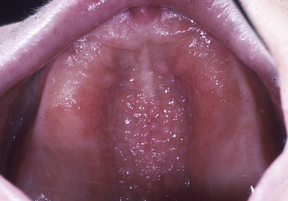 FIG. 3.1, Inflammatory papillary hyperplasia of the palatal mucosa.