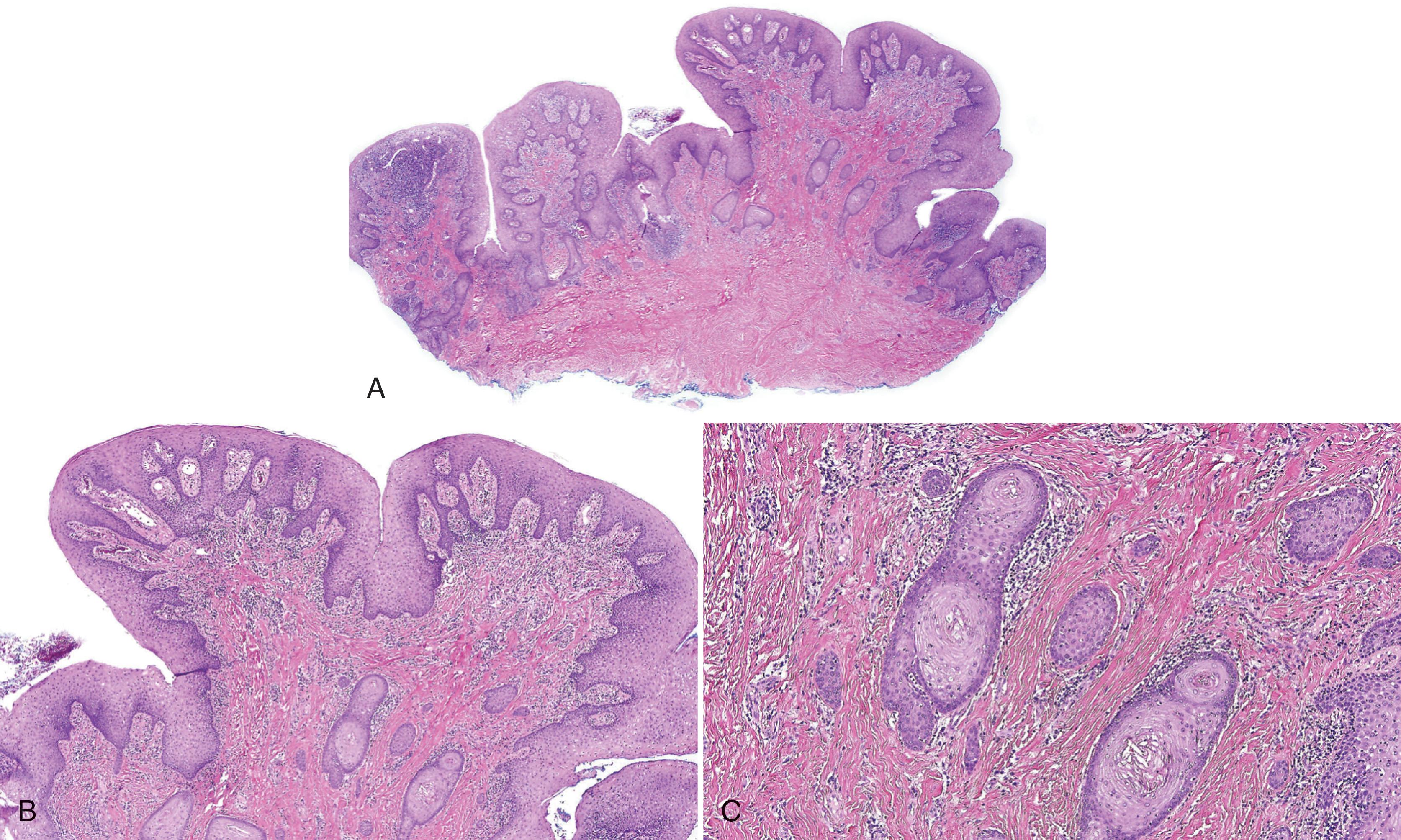 FIG. 3.2, Inflammatory papillary hyperplasia of the palatal mucosa. (A) Papillary proliferation of fibrous tissue and epithelium. (B) Fibroepithelial and pseudoepitheliomatous hyperplasia with chronic inflammation. (C) Islands of benign epithelial cells.