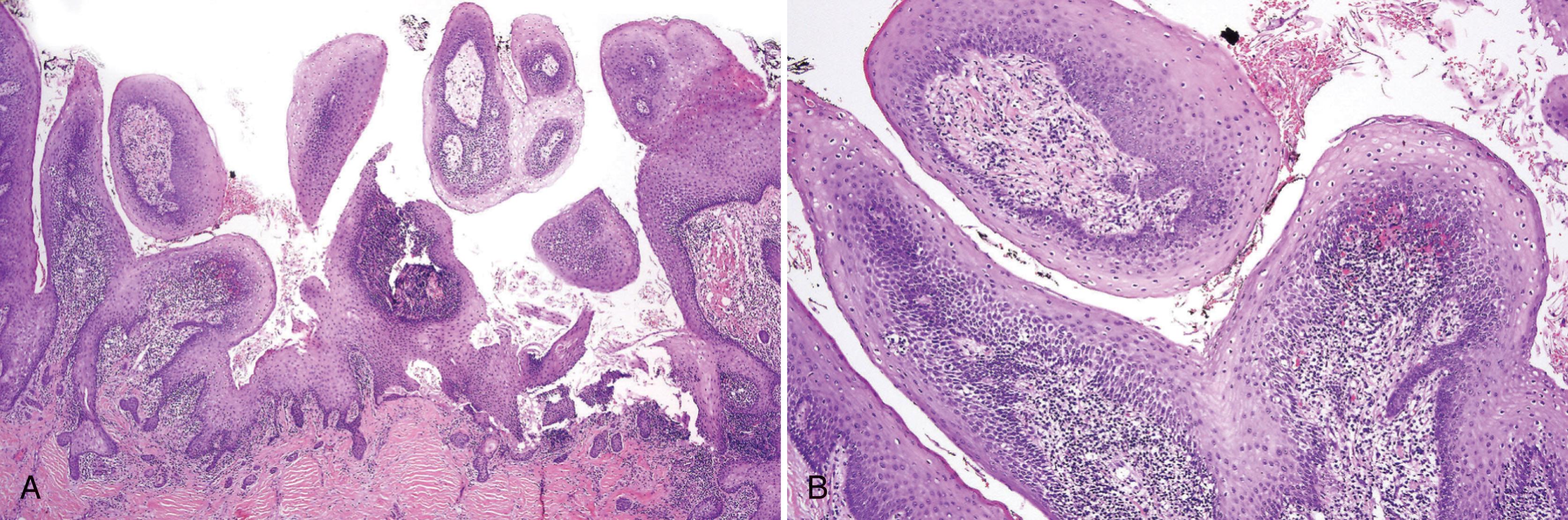 FIG. 3.3, Inflammatory papillary hyperplasia of the palate. (A) Papillary proliferation of fibrous tissue and epithelium. (B) Papillary structures, spongiosis, and chronic inflammation.