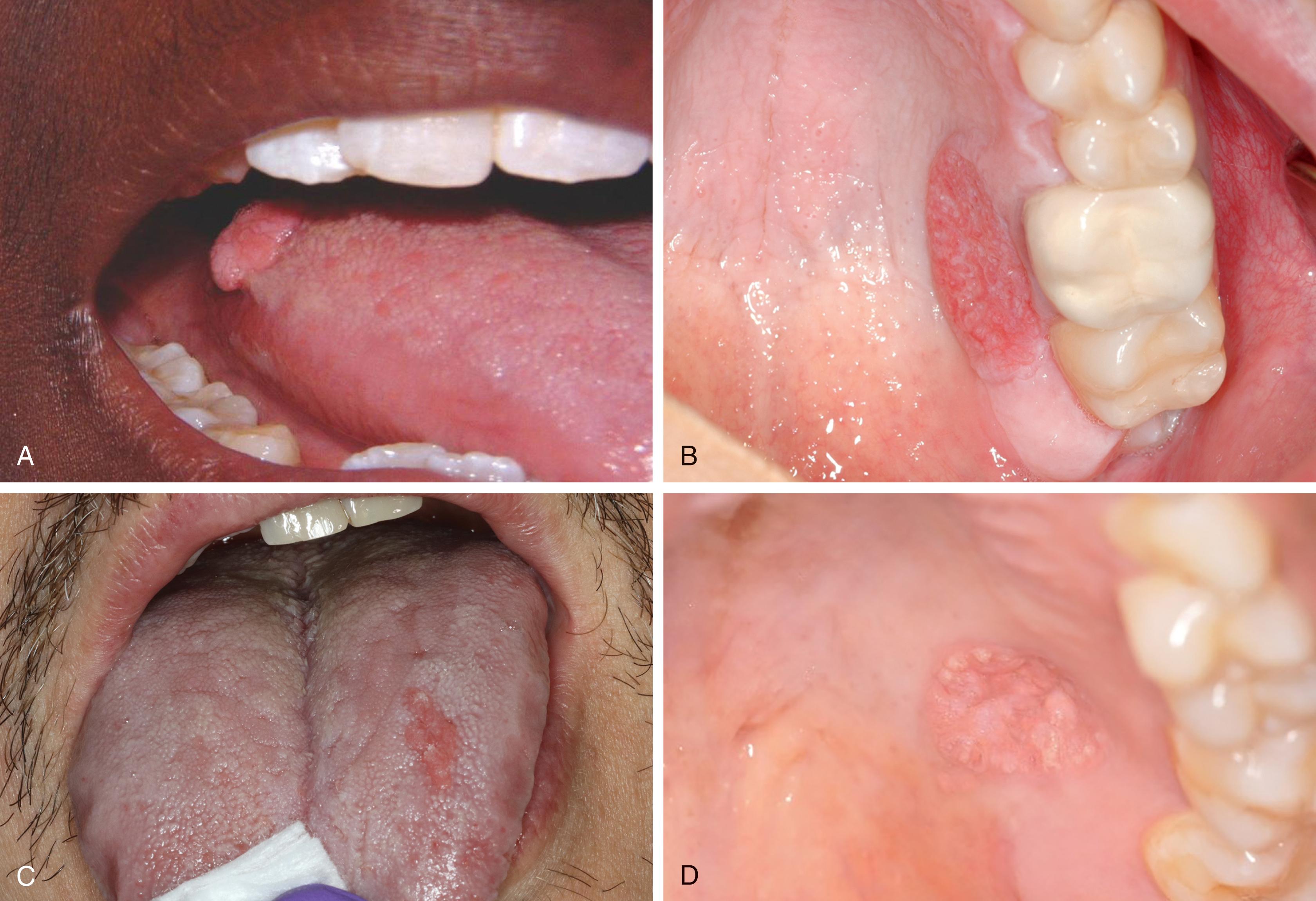 FIG. 3.5, Verruciform xanthoma. (A) Papillary nodule of the right lateral tongue. (B) Yellowish-red plaque of the left hard palatal mucosa. (C) Yellowish-red plaque of the left tongue dorsum. (D) Yellowish plaque on the hard palatal mucosa.