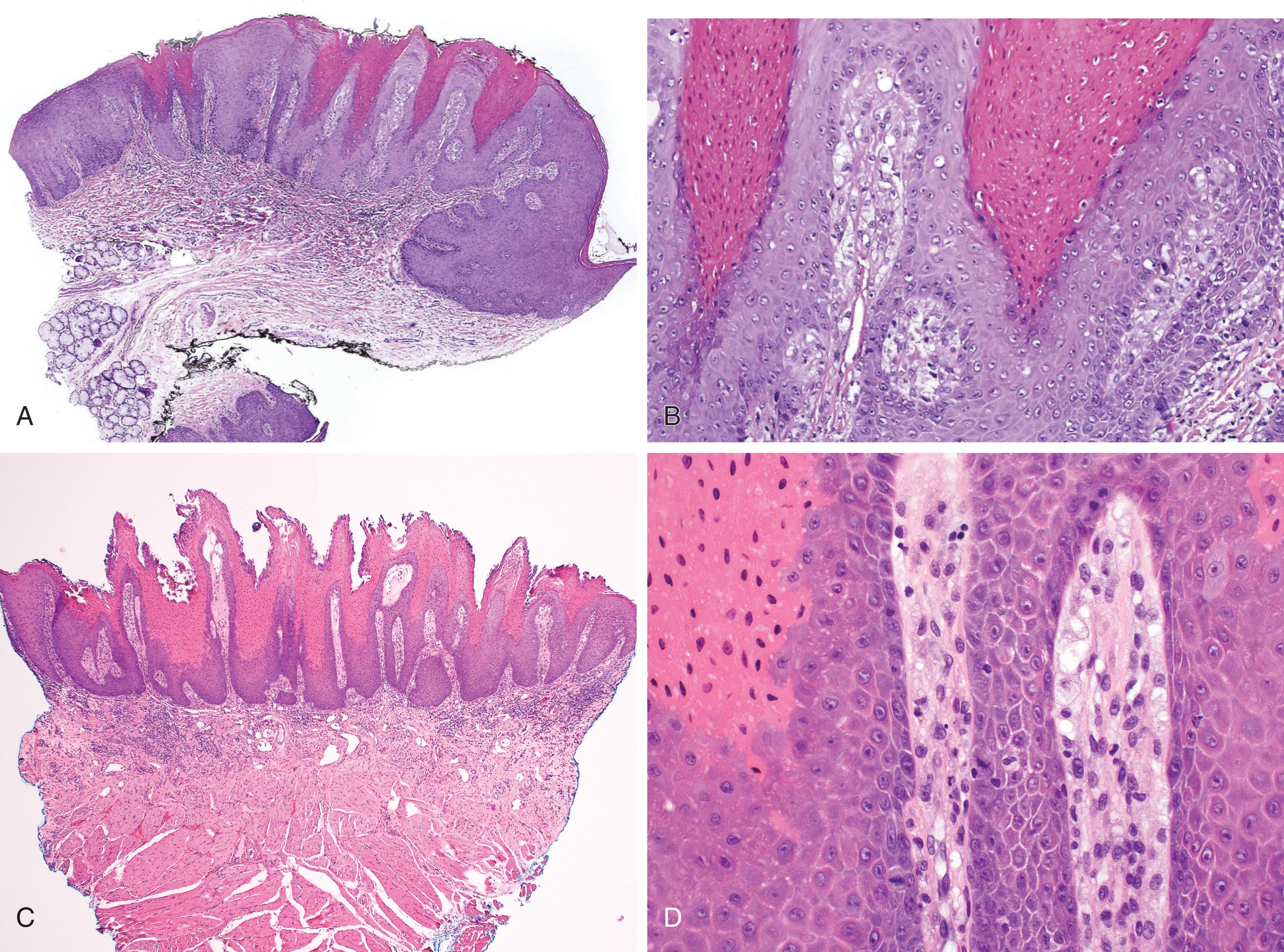 FIG. 3.6, Verruciform xanthomas. (A) Brightly eosinophilic parakeratin, parakeratin plugs, and papillary acanthosis. (B) Compact parakeratosis and foamy macrophages in the lamina propria. (C) Brightly eosinophilic parakeratin with surface keratin squames and acanthosis with rete ridges of equal length. (D) Foamy macrophages in the lamina propria.