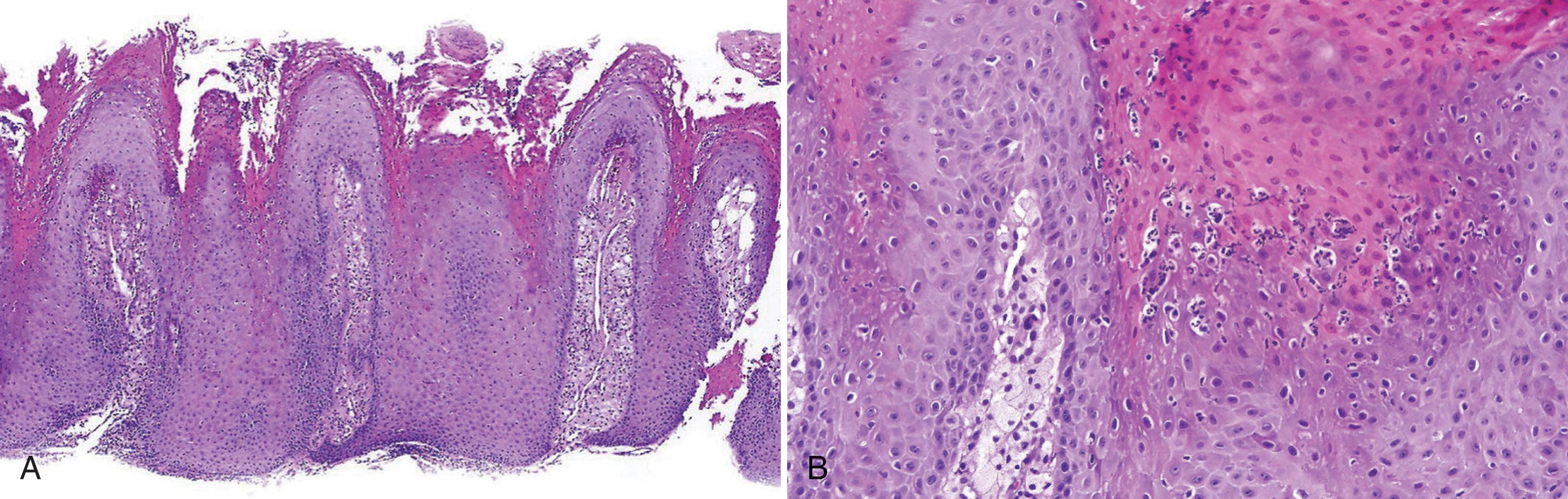 FIG. 3.7, Verruciform xanthoma. (A) Parakeratosis, papillary epithelial hyperplasia, surface keratin squames, and rete ridges of equal length. (B) Parakeratosis, spongiotic pustules without candida, and foamy macrophages within the lamina propria.