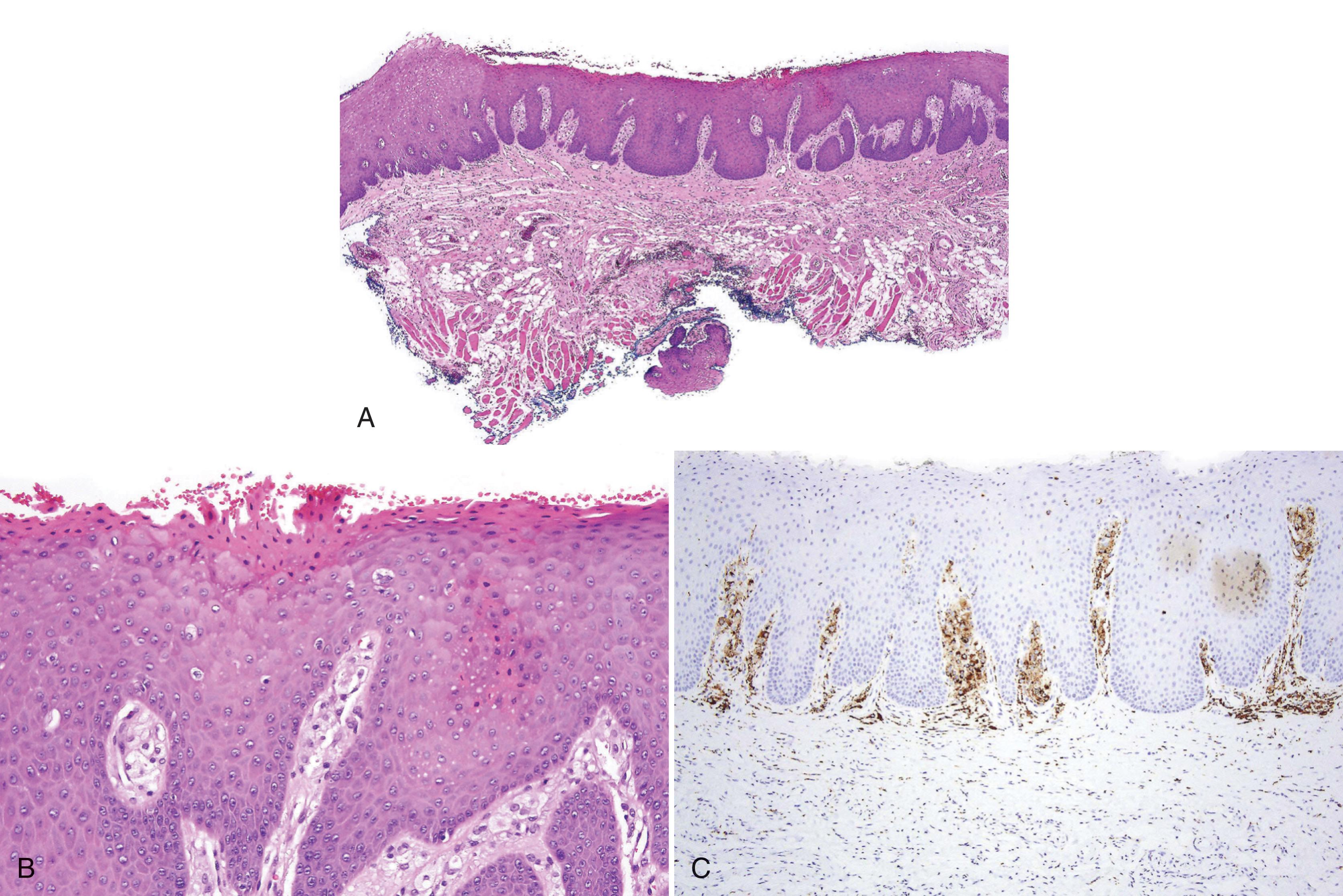 FIG. 3.8, Verruciform xanthoma. (A) Parakeratosis and acanthosis without papillomatosis. (B) Parakeratosis, keratin squames and foamy macrophages. (C) CD68+ macrophages in the papillary lamina propria.