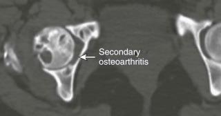 FIGURE 63–1, Pigmented villonodular synovitis (PVNS). Like synovial osteochondromatosis, PVNS should be considered whenever a young adult presents with a monarticular noninflammatory arthropathy. Similarly, the degree of erosion is inversely proportional to the joint capacity and is also related to extent/distribution of synovial proliferation. Unlike synovial osteochondromatosis, calcification is not a characteristic of PVNS.