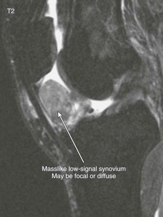 FIGURE 63–2, Pigmented villonodular synovitis (PVNS) can be focal or diffuse; also, the amount of hemosiderin and therefore signal intensity on T2-weighted images varies. The differential for dark synovium includes PVNS, synovial osteochondromatosis, gout, hemophilia, amyloid, postoperative, and chronic arthropathy with scarring.