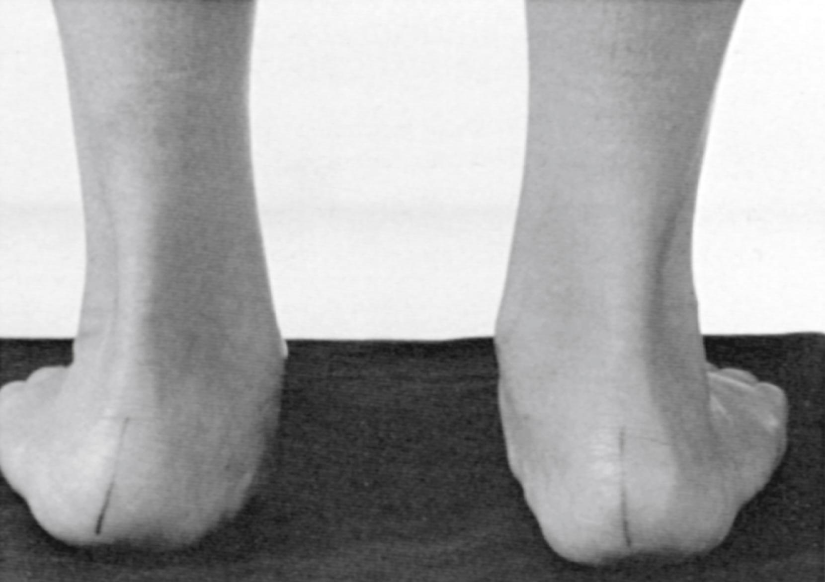 Fig. 50.1, Pes Planus with hindfoot valgus.