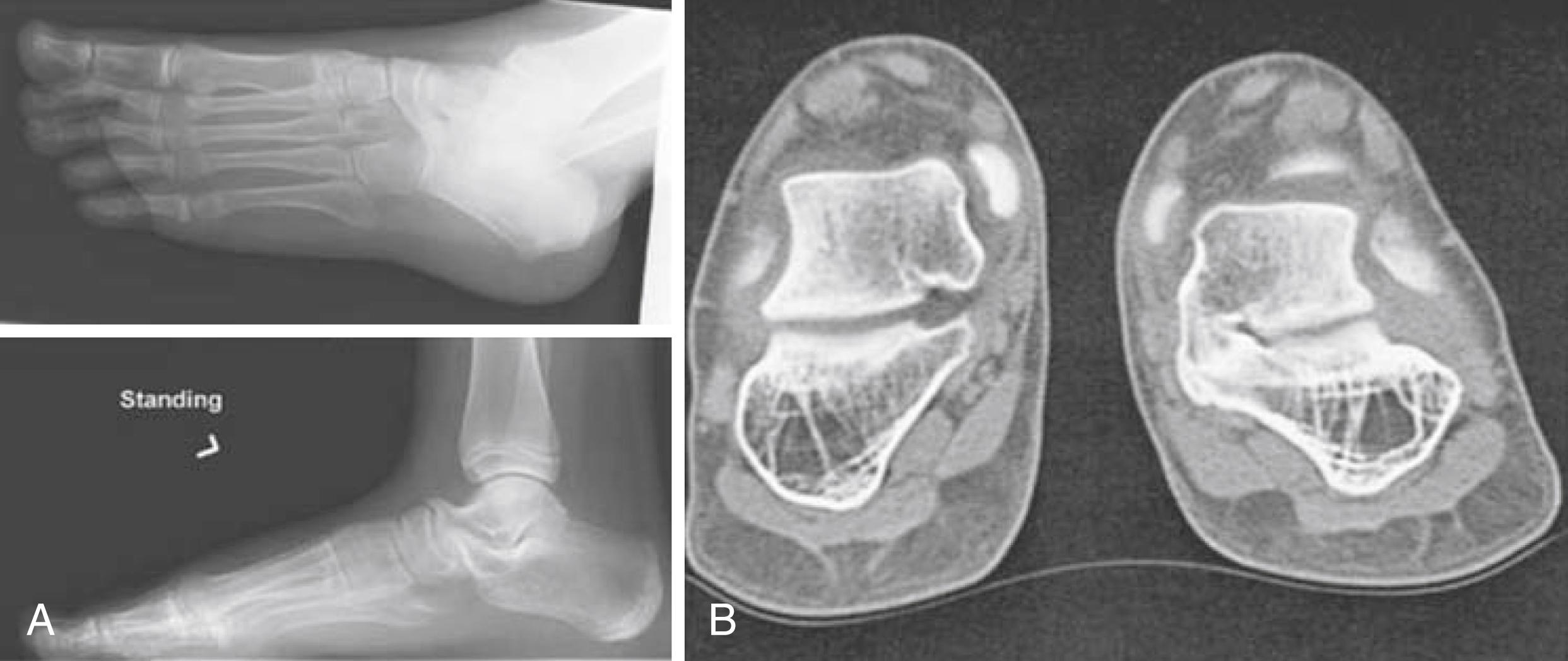 Fig. 50.2, A, Standing lateral images of the left foot together with oblique images in this 10-year-old with left flat foot clinically. Alignment of mid and hind feet looks normal. There is, however, evidence of calcaneal-navicular coalition on the left associated with both talar and calcaneal beaking. (Courtesy Dr. R. Cairns.) B, Computed tomography illustrates the bony bridge between the calcaneus and talus on the right side. The left hind foot is normal. This feature may not be detectable on plain radiographs.