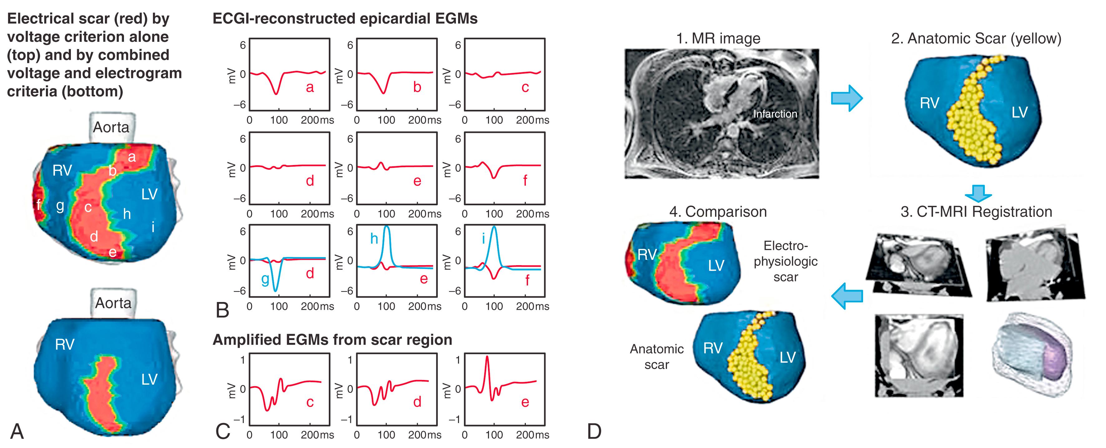 Fig. 68.1, Electrocardiographic imaging (ECGI)-derived electrical scar and magnetic resonance image of anatomic scar.