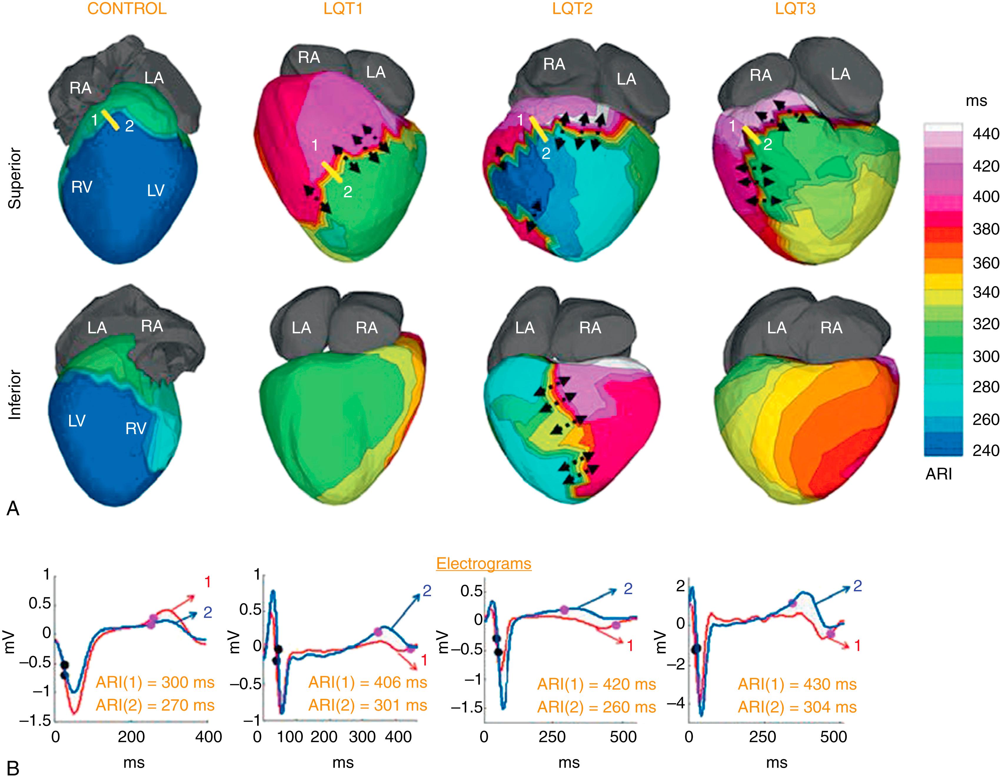 Fig. 68.4, Activation-recovery interval (ARI) maps in long QT syndrome (LQTS) patients.