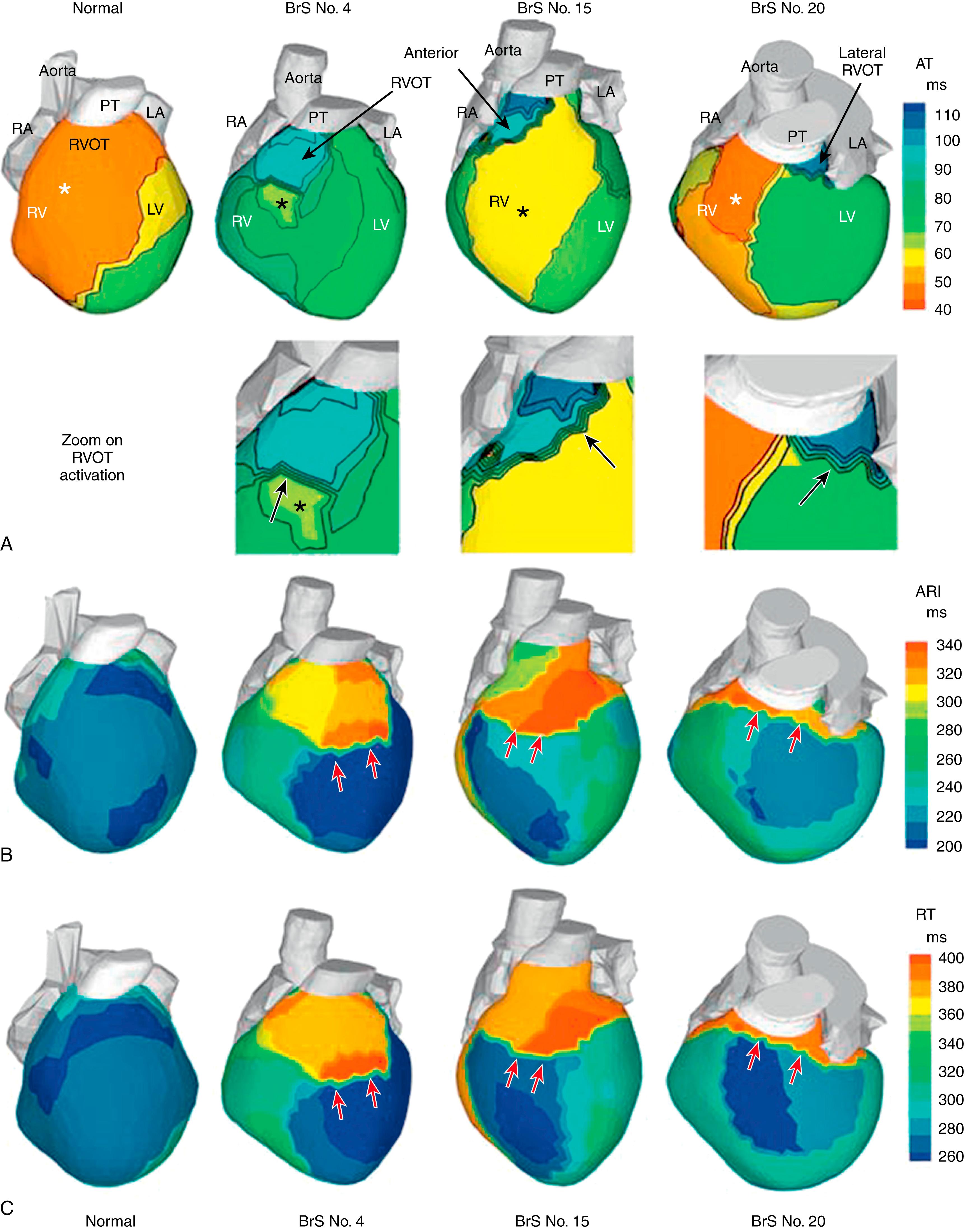 Fig. 68.5, Activation and repolarization in Brugada syndrome (BrS) patients during sinus rhythm.