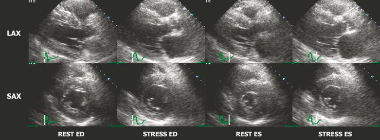 Fig. 4.2, Abnormal stress echo in a patient with severe multivessel coronary artery disease.