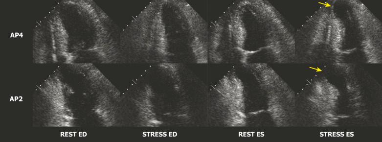 Fig. 4.3, Abnormal stress echo in a patient with severe stenosis of the mid–left anterior descending coronary artery.