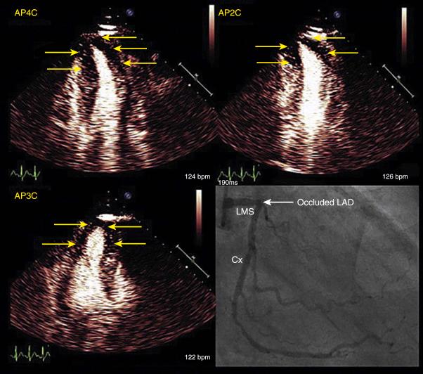 Fig. 4.4, A 56-year-old male smoker with hypertension who reported chest pain underwent standard echocardiography (SE) and myocardial contrast echocardiography (MCE) . SE showed a wall motion abnormality in only one segment (apical septum), but MCE revealed clear myocardium perfusion defects (arrows) in six segments in the apical four-chamber (AP4C) , apical two-chamber (AP2C) , and apical three-chamber (AP3C) views. Angiography (bottom right) revealed a completely occluded left anterior descending (LAD) coronary artery, which was successfully reopened. Bpm, Beats per minute; Cx, circumflex artery; LMS, left main stem.