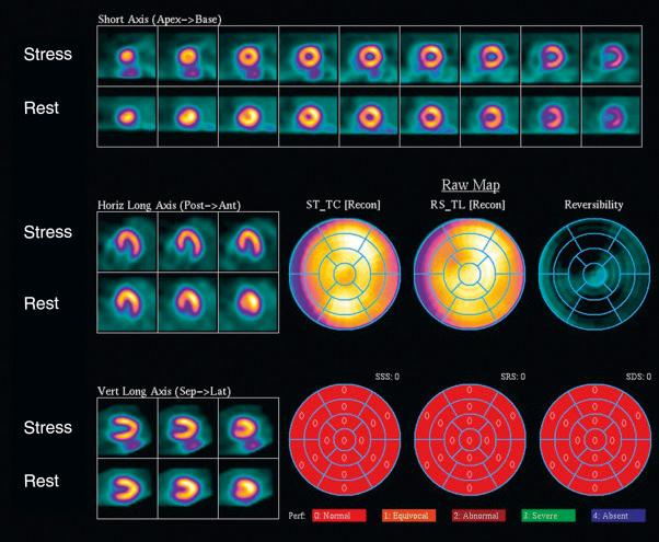 Fig. 4.5, Single-photon emission computed tomography technetium-99m sestamibi exercise stress study.