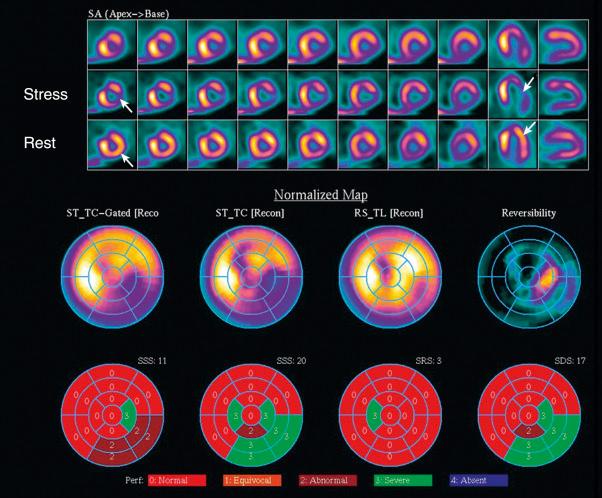 Fig. 4.6, Single-photon emission computed tomography technetium-99m sestamibi exercise stress study.