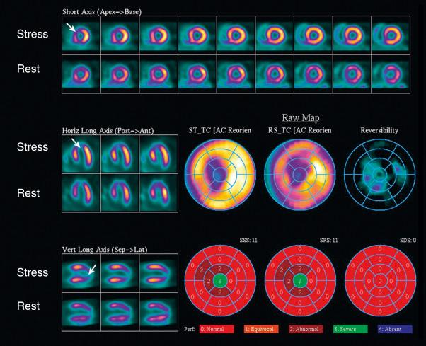 Fig. 4.7, Single-photon emission computed tomography technetium-99m sestamibi exercise stress study.