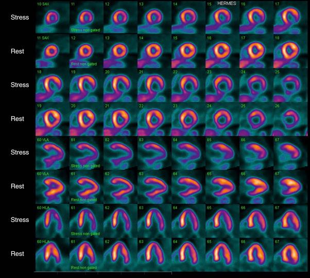 Fig. 4.8, Positron emission tomography cardiac perfusion study using nitrogen-13 ammonia.