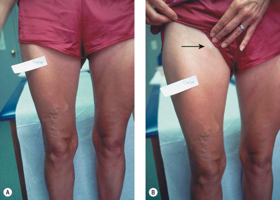 Figure 5.1, A, This patient sought treatment for an obviously enlarged vein in her thigh. B, Further inspection revealed a saphena varix (arrow) indicative of saphenofemoral junction insufficiency.